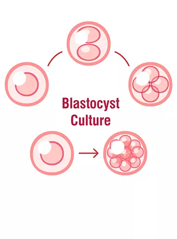 Blastocyst culture and transfer
